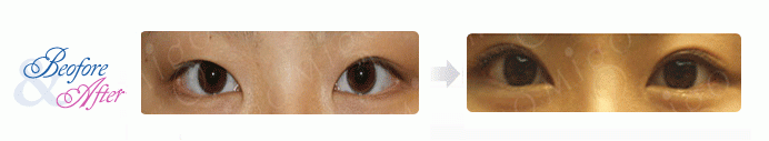 Oculoplastic_3.gif