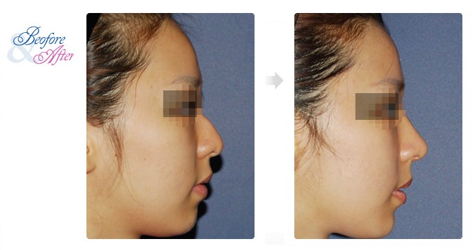 3D_Rhinoplasty_4.jpg