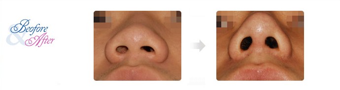 3D_Rhinoplasty_6.jpg