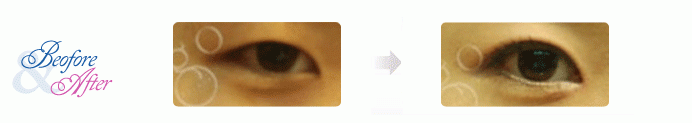 Oculoplastic_4.gif