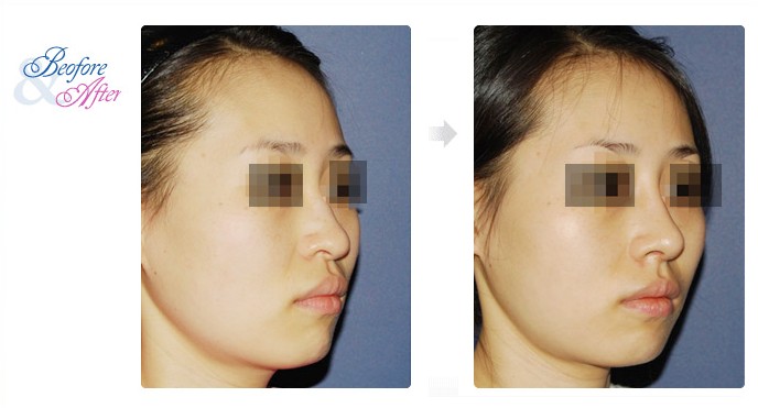 3D_Rhinoplasty_5.jpg