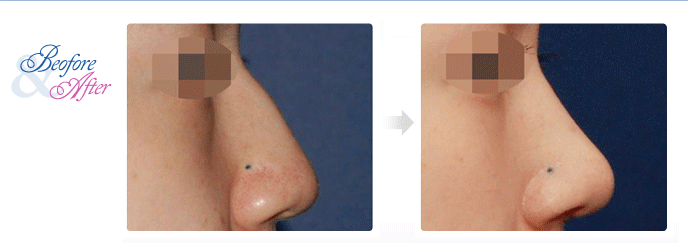 3D_Rhinoplasty.gif