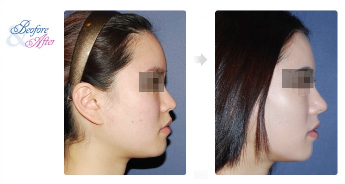 3D_Rhinoplasty.jpg