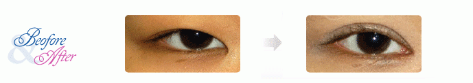 Oculoplastic_5.gif