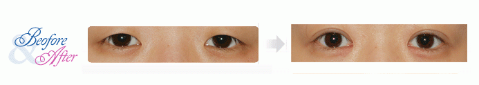 Oculoplastic_7.gif