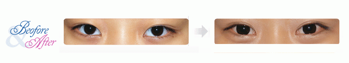 Oculoplastic_6.gif