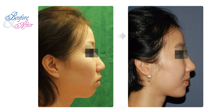 3D_Rhinoplasty_2.gif