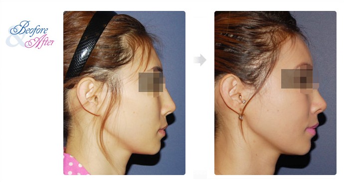 3D_Rhinoplasty_3.jpg